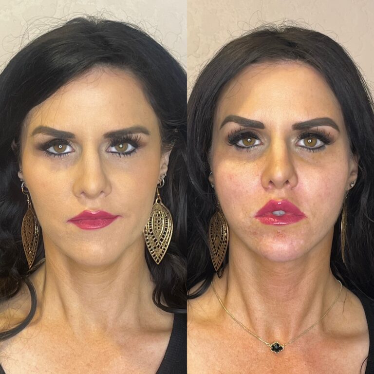 Desert Bloom patient — PDO thread lift result, case 32