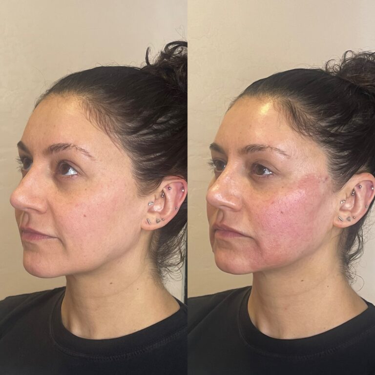 Desert Bloom patient — PDO thread lift result, case 33