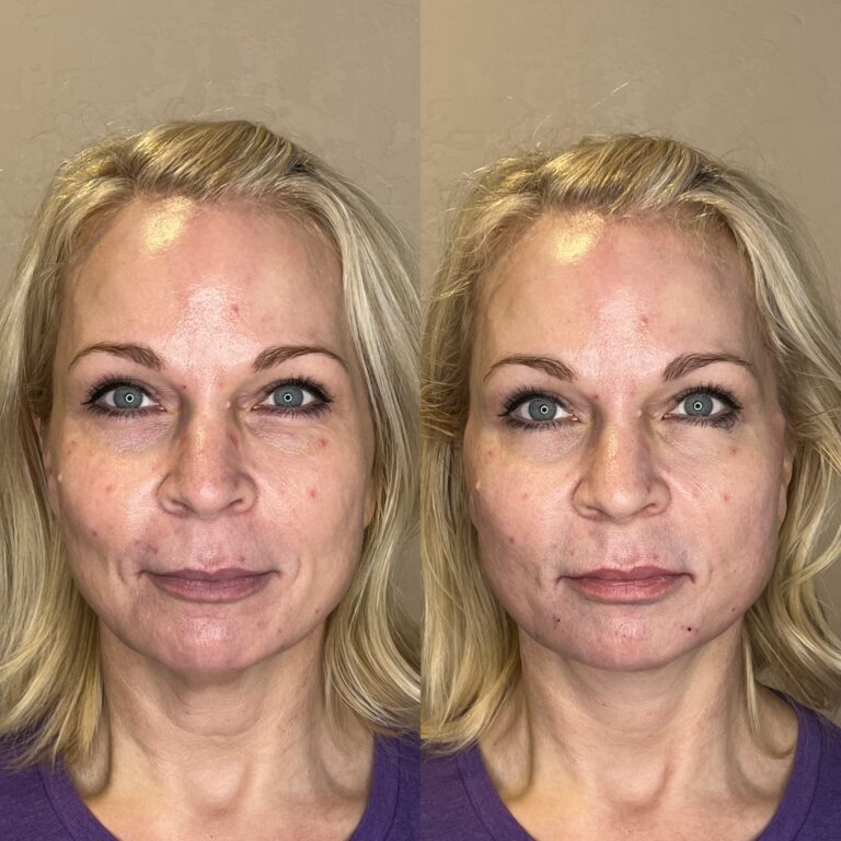 Desert Bloom patient — PDO thread lift result, case 34