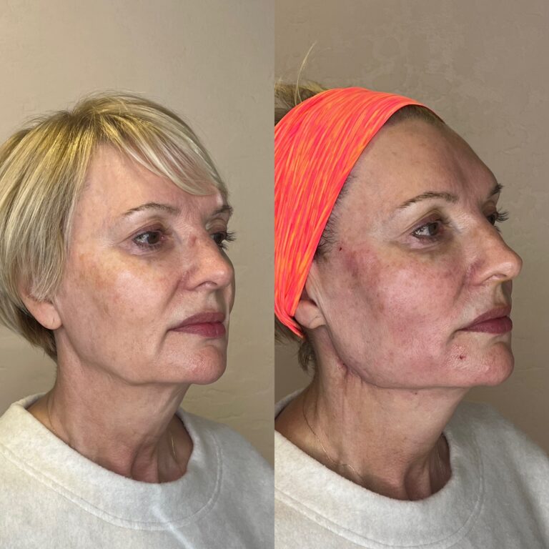 Desert Bloom patient — PDO thread lift result, case 35