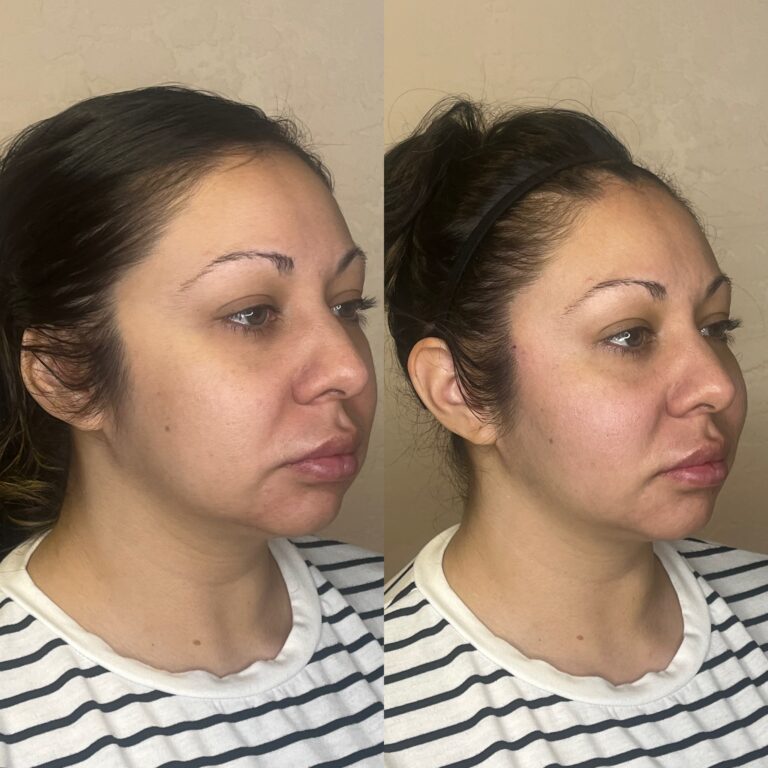 Desert Bloom patient — PDO thread lift result, case 36
