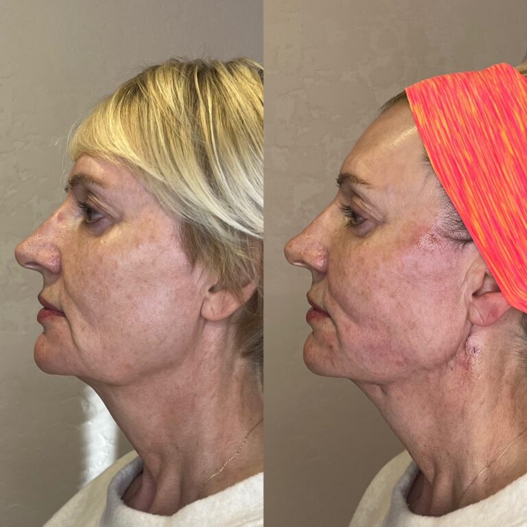 Desert Bloom patient — PDO thread lift result, case 38