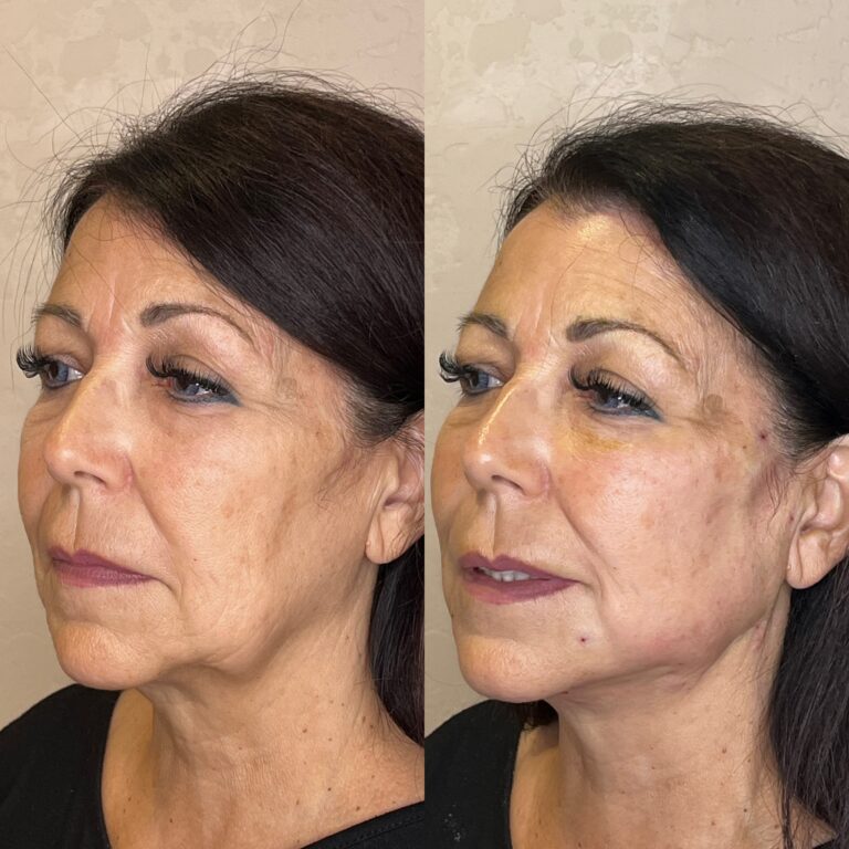 Desert Bloom patient — PDO thread lift result, case 4
