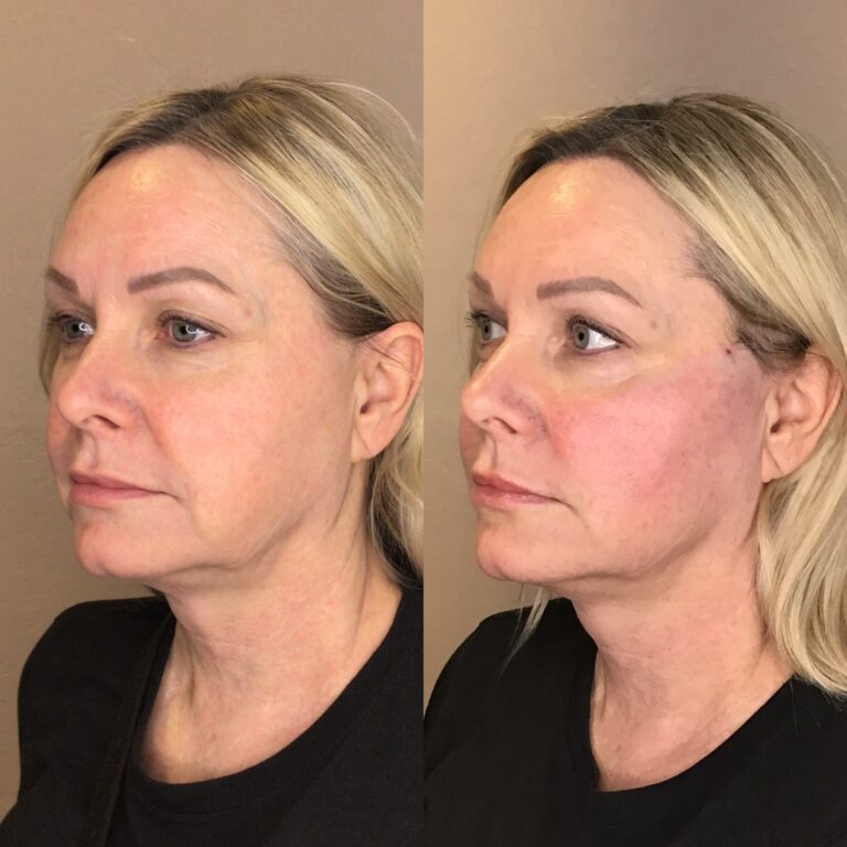 Desert Bloom patient — PDO thread lift result, case 40