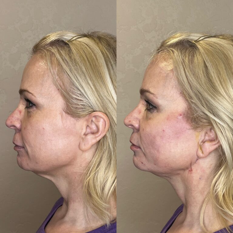 Desert Bloom patient — PDO thread lift result, case 41
