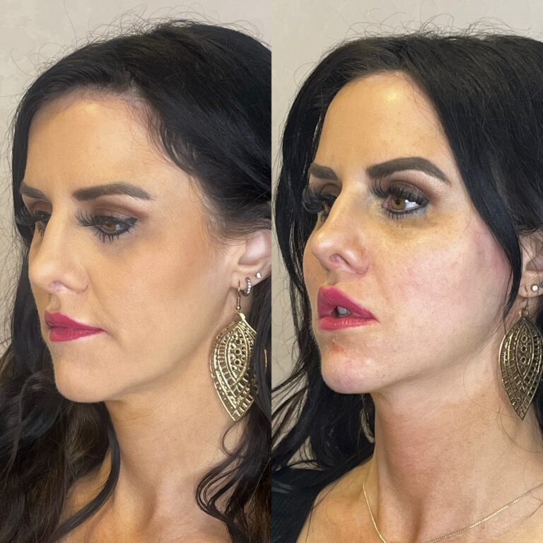 Desert Bloom patient — PDO thread lift result, case 42