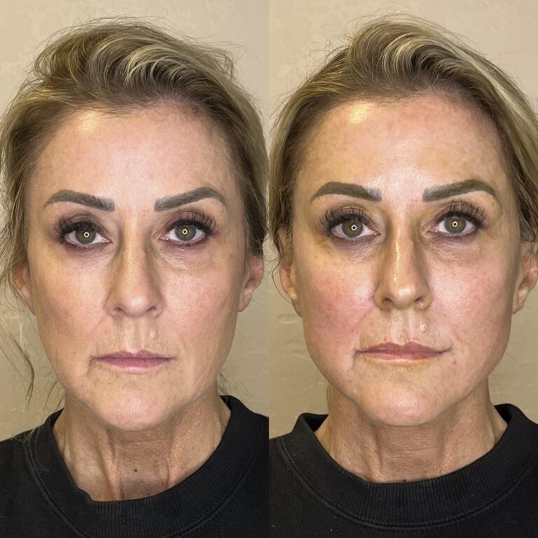 Desert Bloom patient — PDO thread lift result, case 43