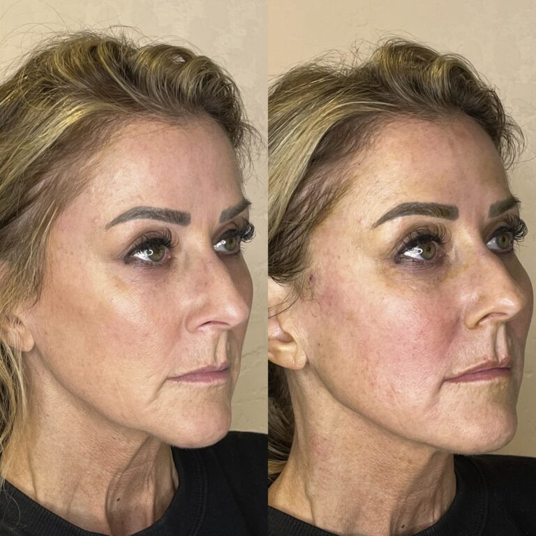 Desert Bloom patient — PDO thread lift result, case 44