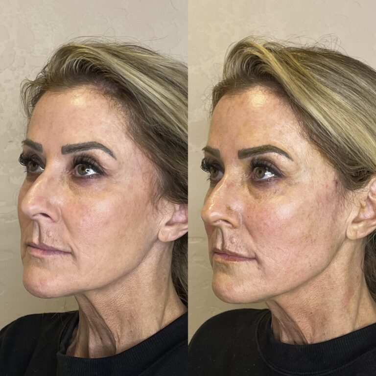Desert Bloom patient — PDO thread lift result, case 45