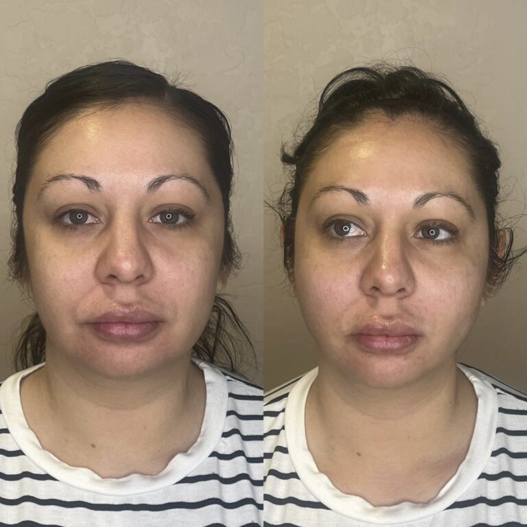 Desert Bloom patient — PDO thread lift result, case 46
