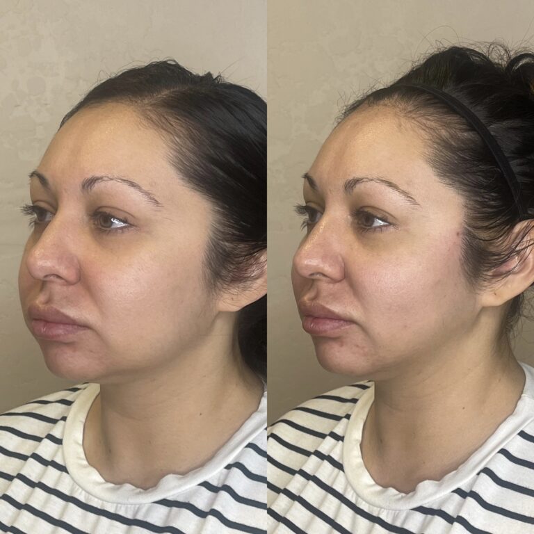 Desert Bloom patient — PDO thread lift result, case 47