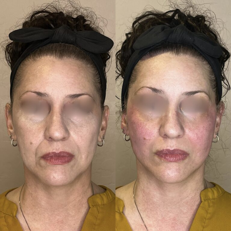 Desert Bloom patient — PDO thread lift result, case 48