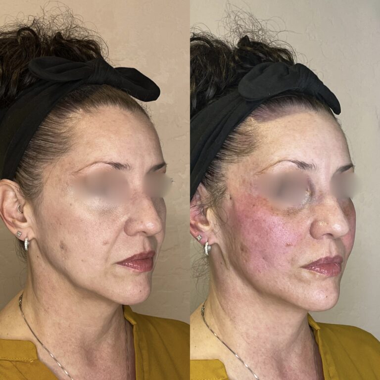 Desert Bloom patient — PDO thread lift result, case 49