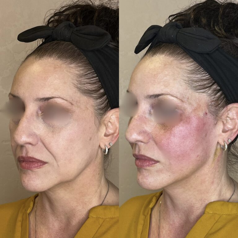 Desert Bloom patient — PDO thread lift result, case 50