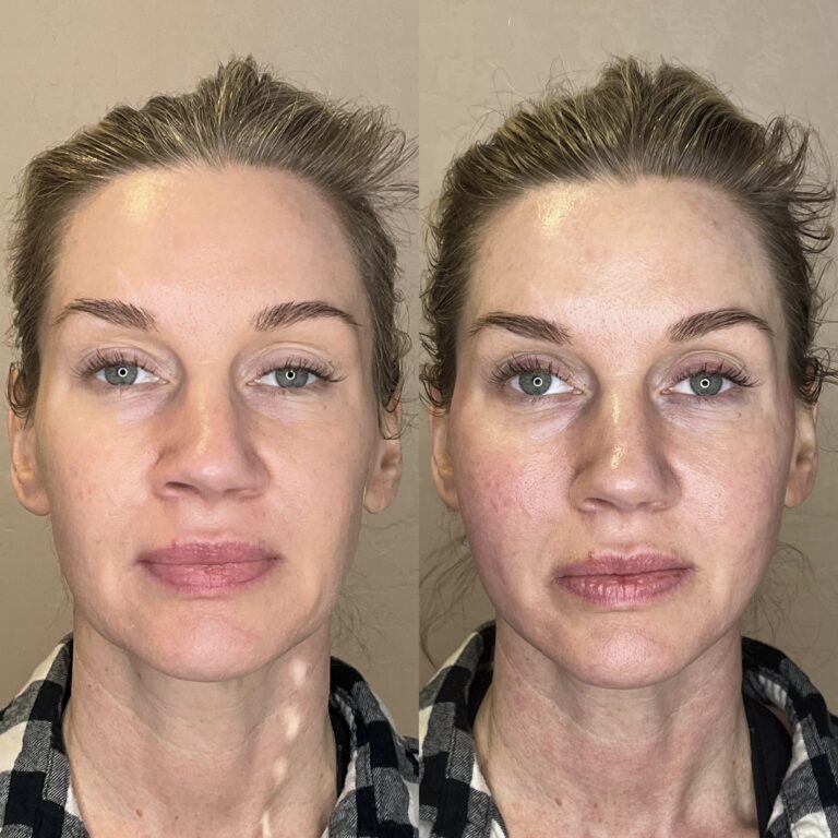 Desert Bloom patient — PDO thread lift result, case 53