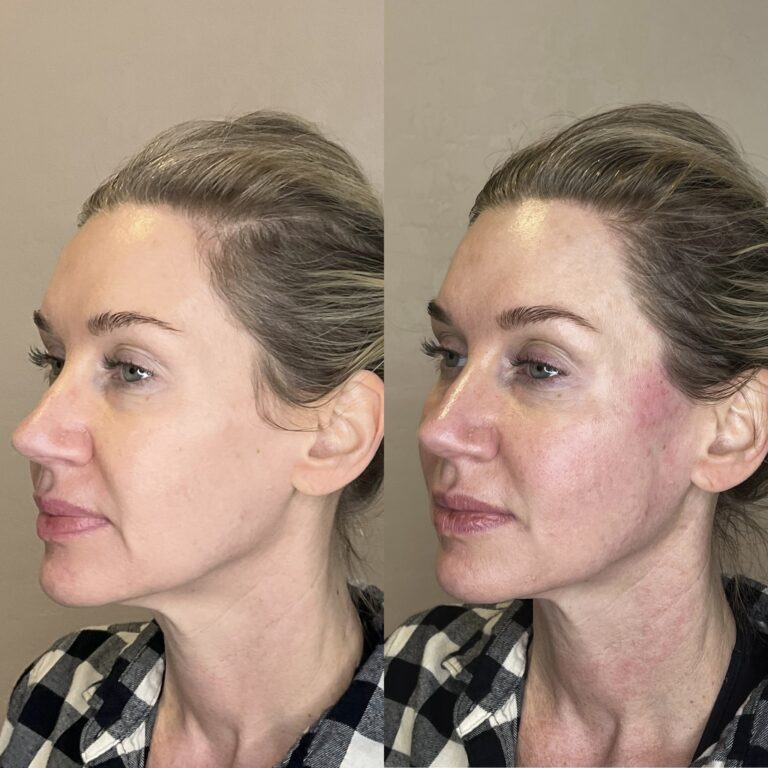 Desert Bloom patient — PDO thread lift result, case 54