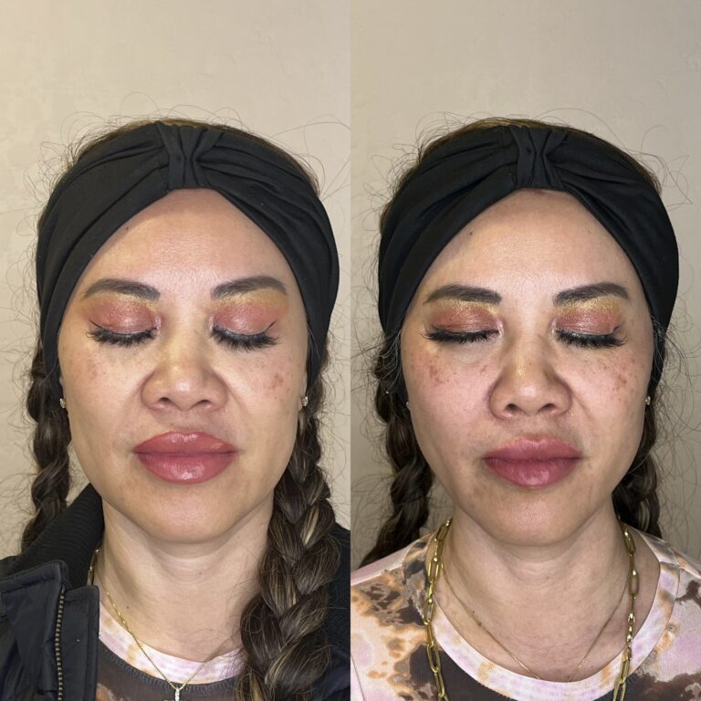 Desert Bloom patient — PDO thread lift result, case 55