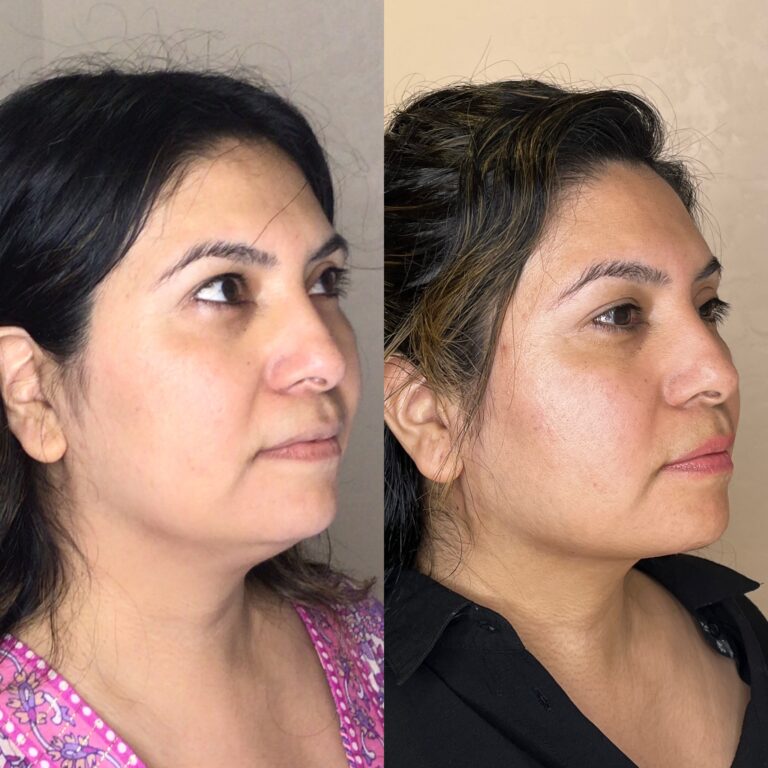 Desert Bloom patient — PDO thread lift result, case 6