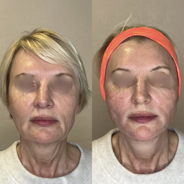 Desert Bloom patient — PDO thread lift result, case 61