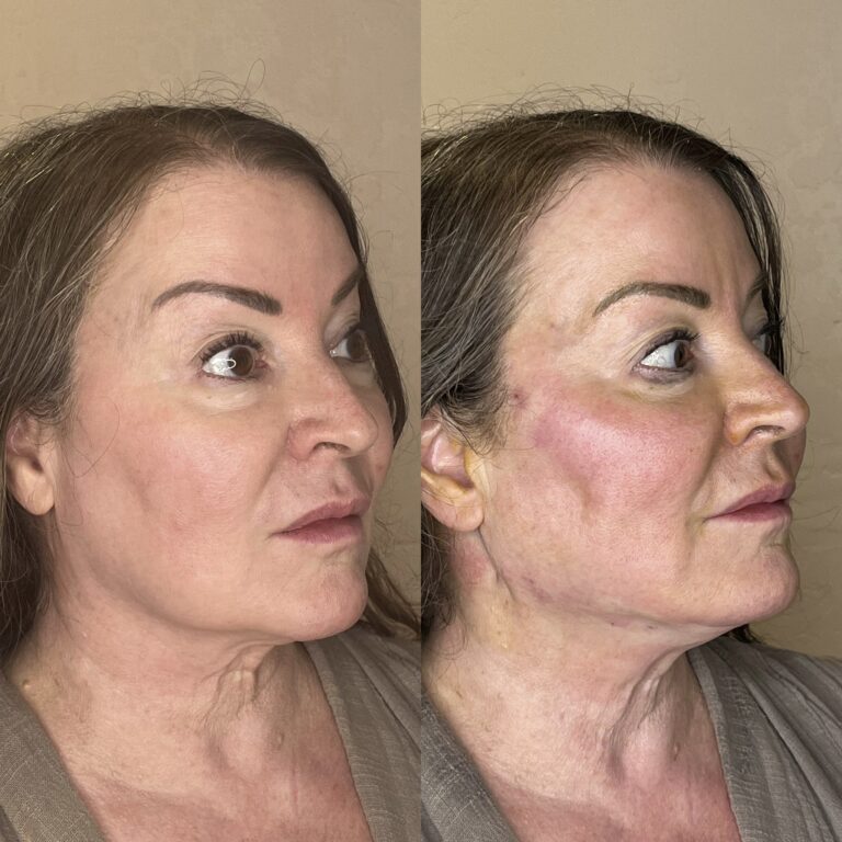 Desert Bloom patient — PDO thread lift result, case 62