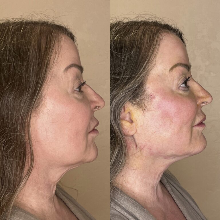 Desert Bloom patient — PDO thread lift result, case 63