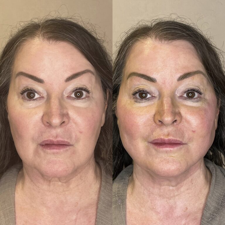 Desert Bloom patient — PDO thread lift result, case 64