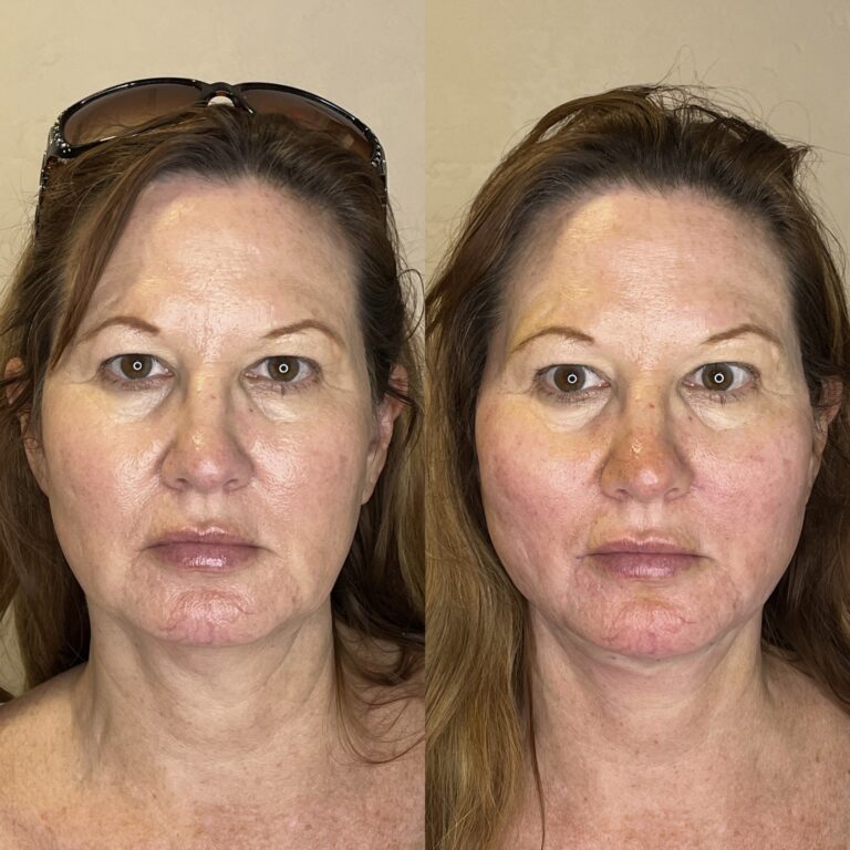 Desert Bloom patient — PDO thread lift result, case 65