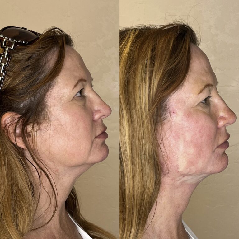 Desert Bloom patient — PDO thread lift result, case 66