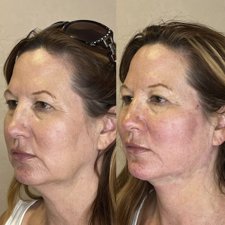 Desert Bloom patient — PDO thread lift result, case 67