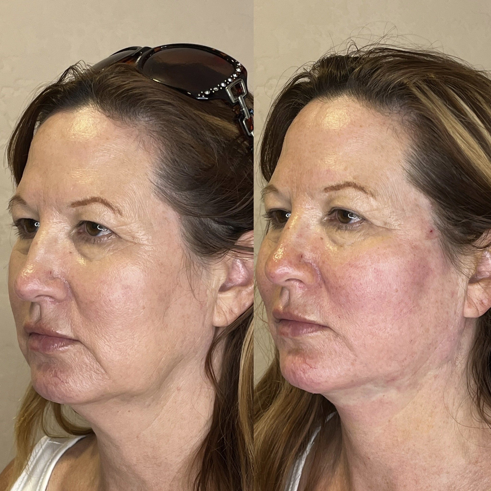 Before and after three-quarter view of a PDO neck thread lift at Desert Bloom Skincare — before