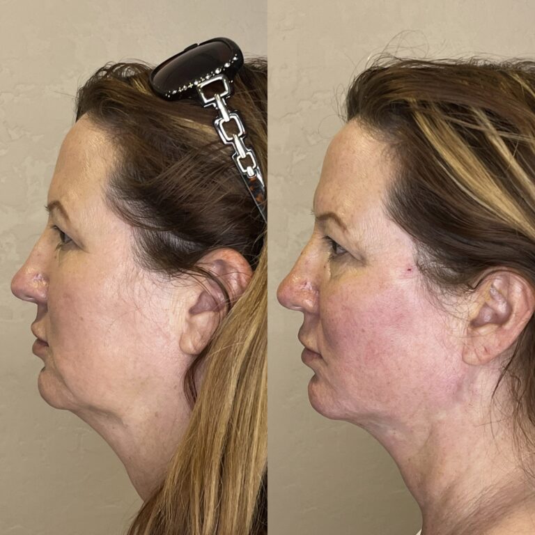 Desert Bloom patient — PDO thread lift result, case 68