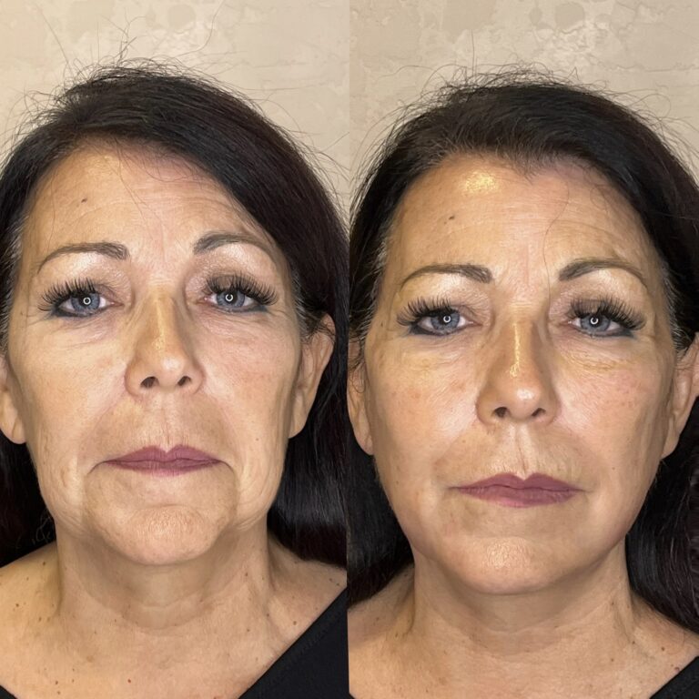 Desert Bloom patient — PDO thread lift result, case 69