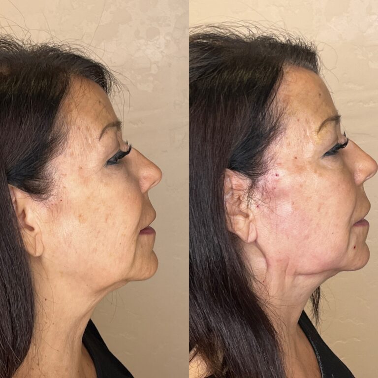 Desert Bloom patient — PDO thread lift result, case 7
