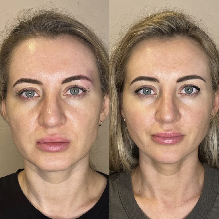 Desert Bloom patient — PDO thread lift result, case 70