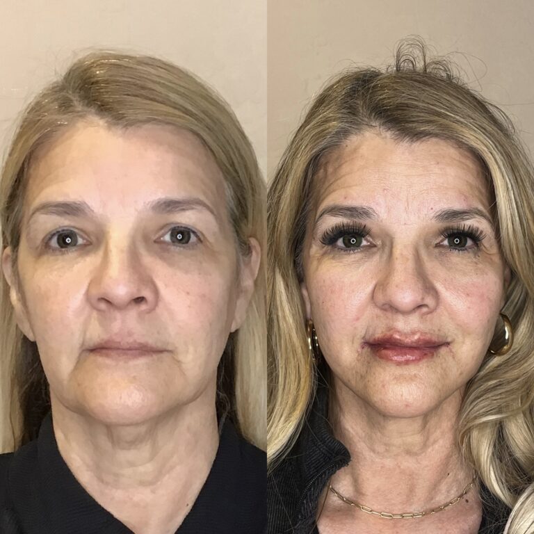 Desert Bloom patient — PDO thread lift result, case 71