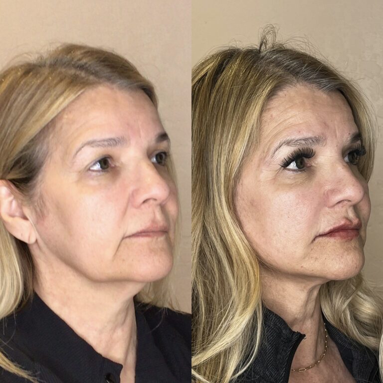 Desert Bloom patient — PDO thread lift result, case 72