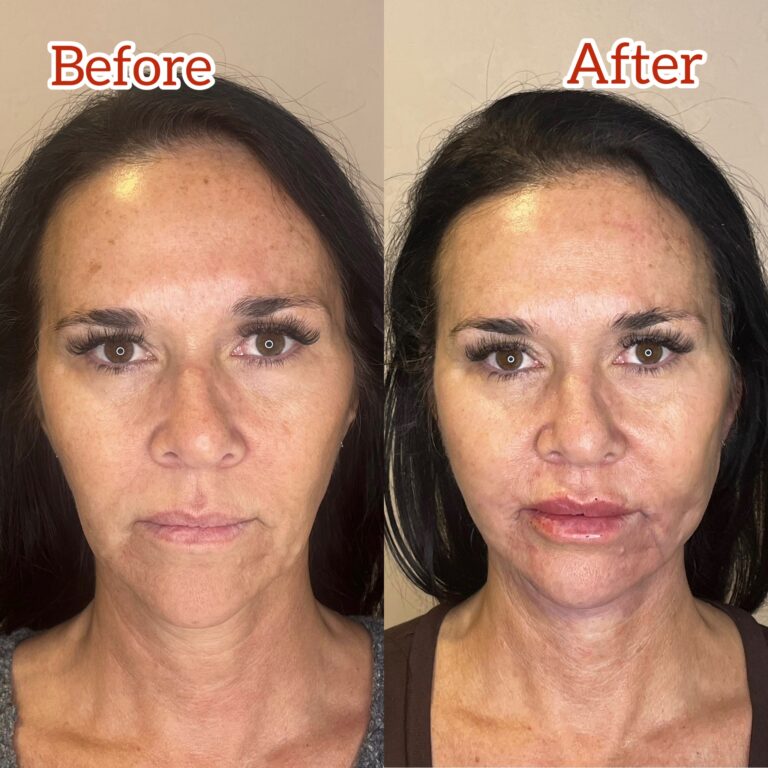 Desert Bloom patient — PDO thread lift result, case 73