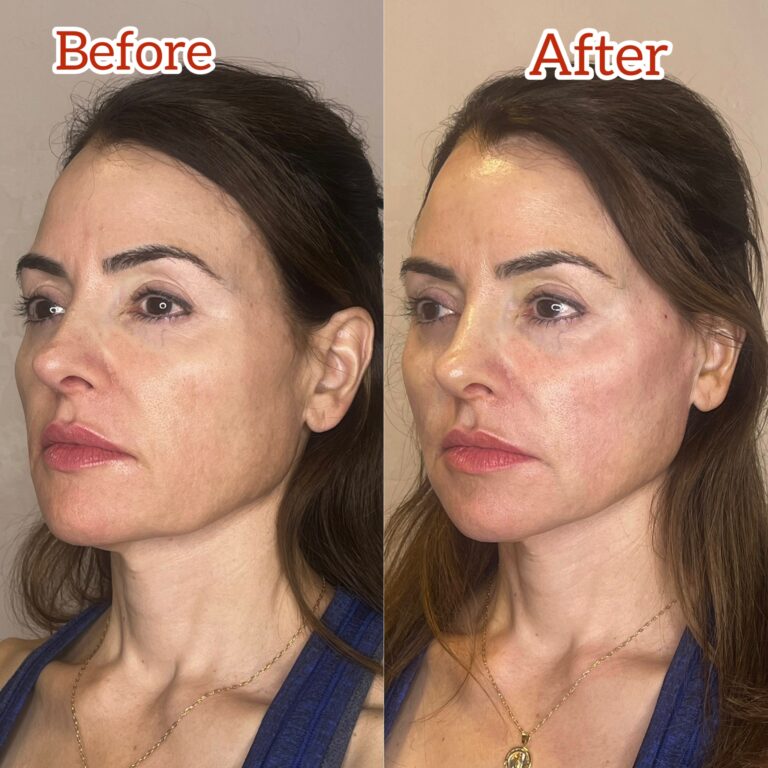 Desert Bloom patient — PDO thread lift result, case 77