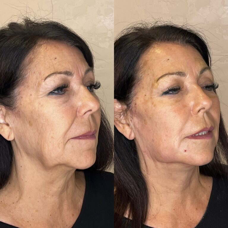 Desert Bloom patient — PDO thread lift result, case 8