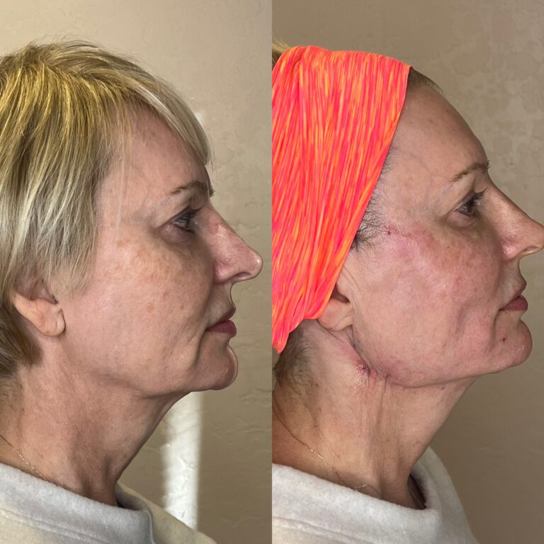 Desert Bloom patient — PDO thread lift result, case 9