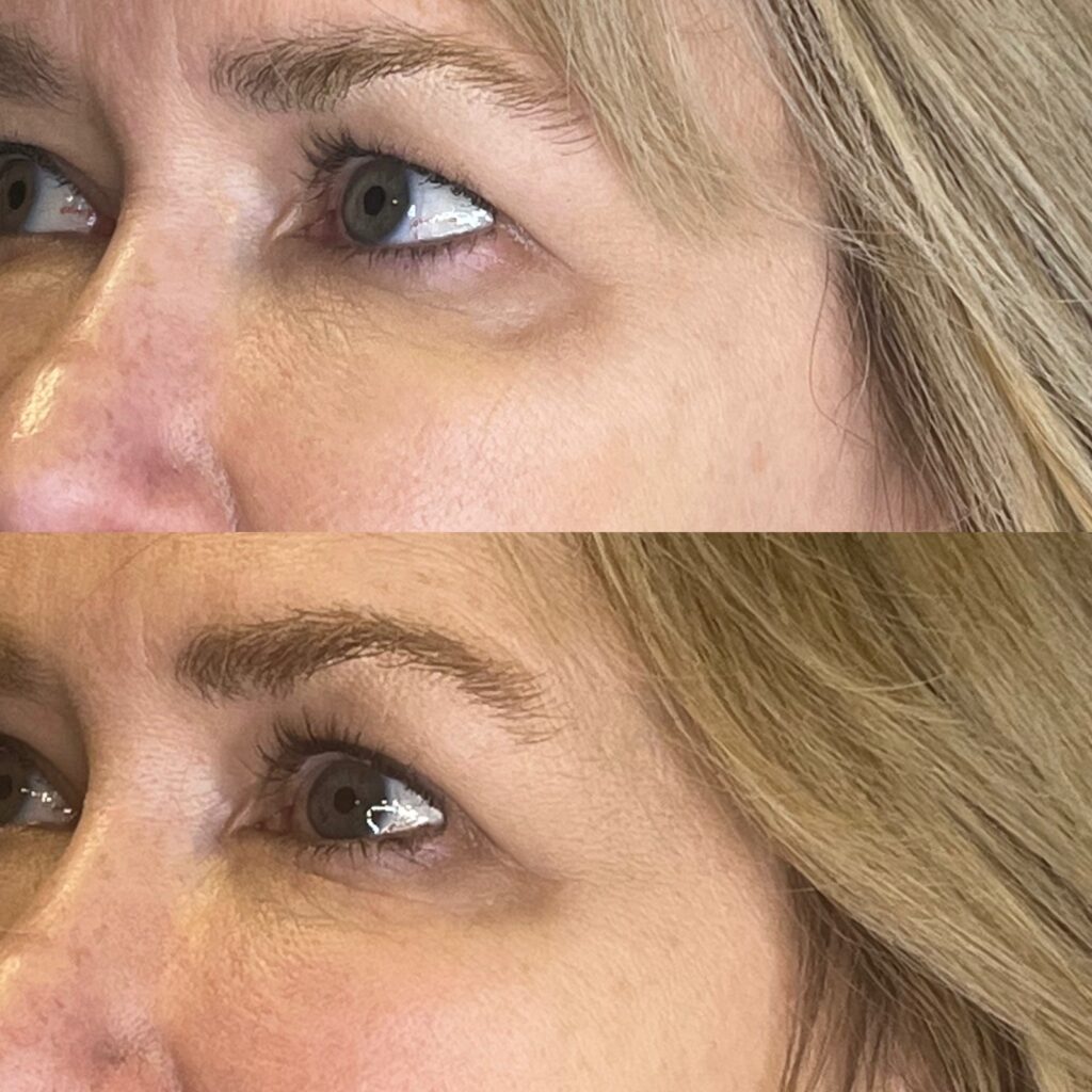PRP Under Eyes result 1