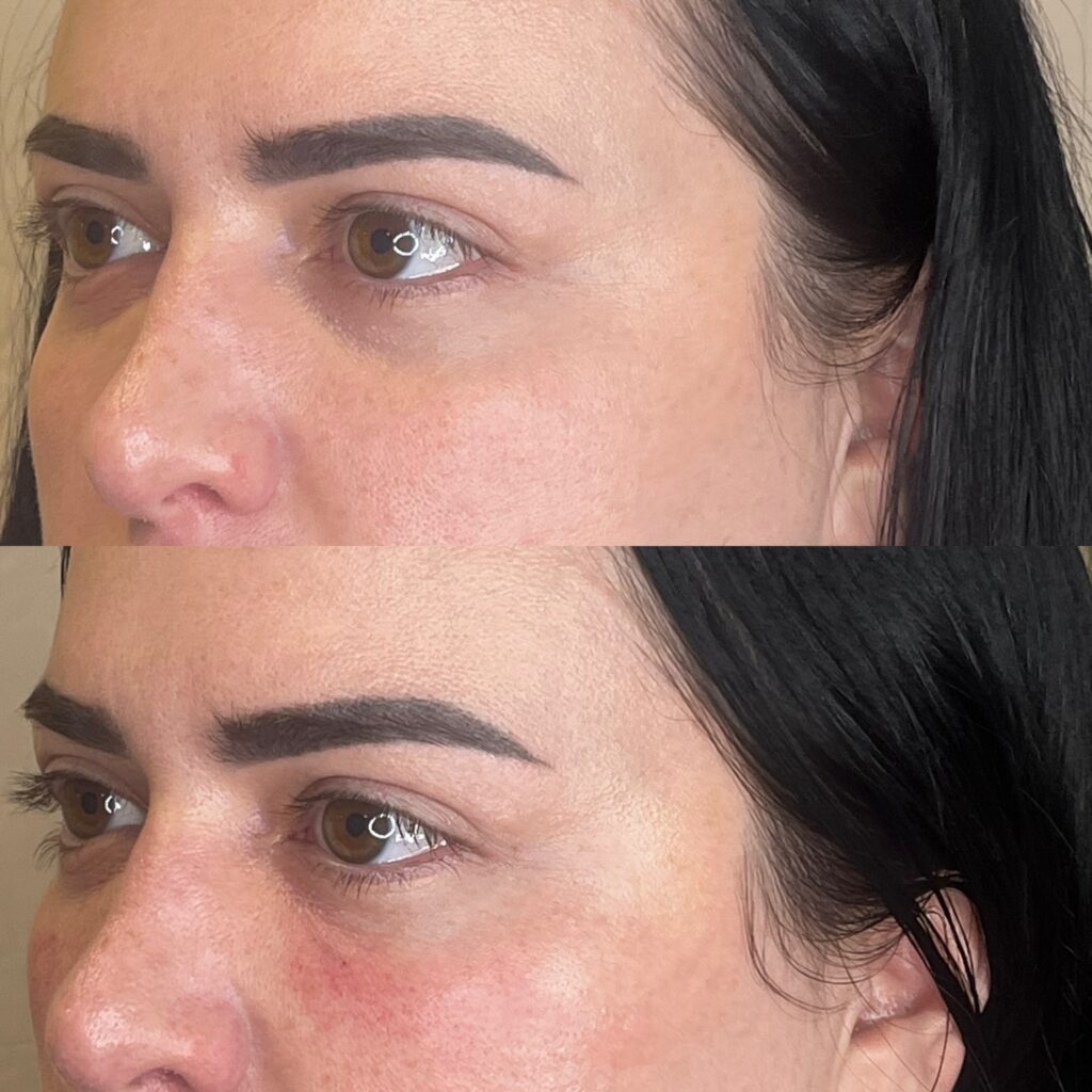 PRP Under Eyes result 2