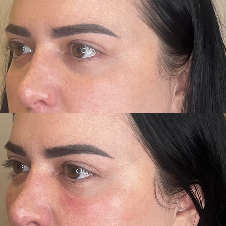 Desert Bloom patient — PRP under eyes result, case 2