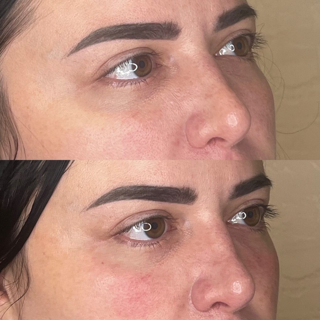 PRP Under Eyes result 3