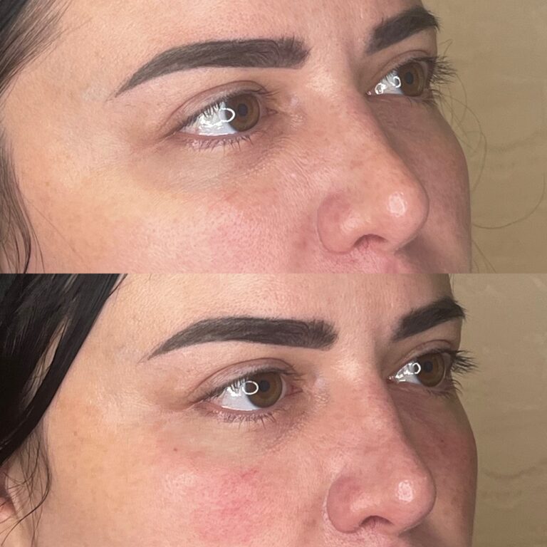 Desert Bloom patient — PRP under eyes result, case 3
