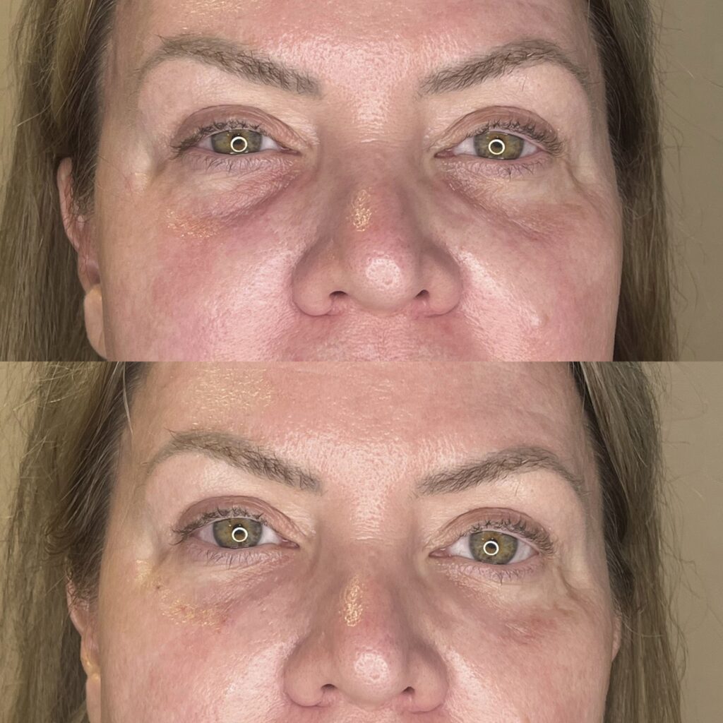 PRP Under Eyes result 4