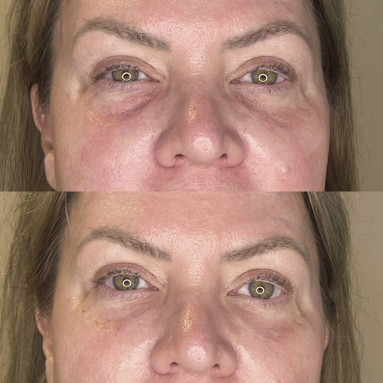 Desert Bloom patient — PRP under eyes result, case 4