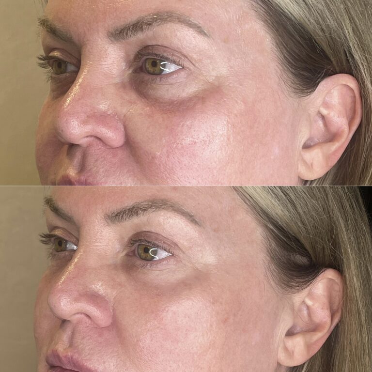 Desert Bloom patient — PRP under eyes result, case 5