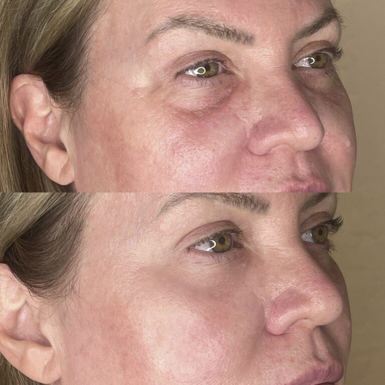 Desert Bloom patient — PRP under eyes result, case 6