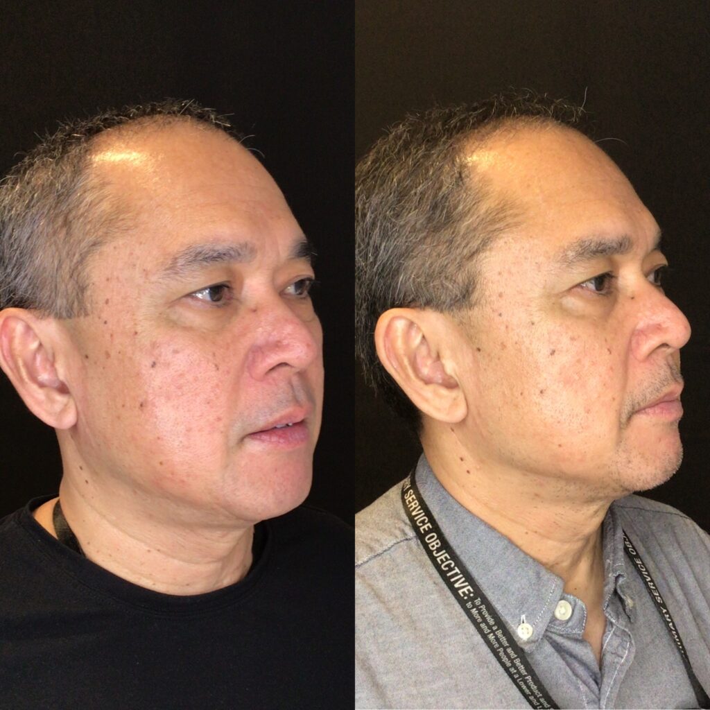 Desert Bloom patient — PRX-T33 result, case 1